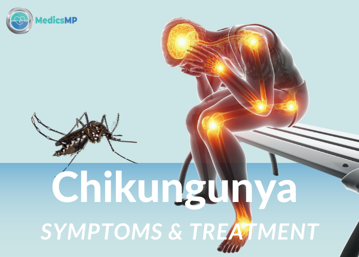 Chikungunya Symptoms & Treatment